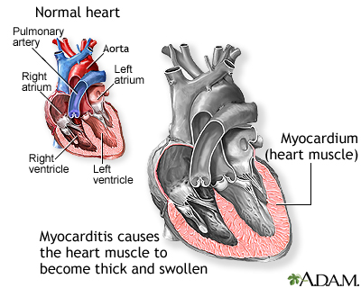 Myocarditis2